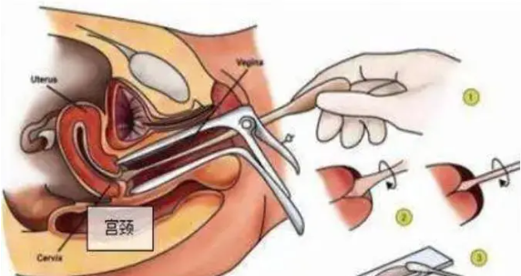 妇科病检查 下面图片